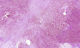 Color image of a 1.5 cm x 1 cm section of adenocarcinoma from human breast acquired using Lumencor’s LIDA light engine and NIS Elements software.
Image courtesy of Dr. Michael Weber (Harvard Medical School).