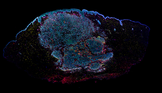 Earth Day Imaging Competition submission of Non-Small Cell Lung Cancer Tissue captured using SPECTRA X Light Engine. 6-plex biomarker profiling of Oral Cavity Tumor tissue (CD3, CD68, CD11c, CD20, Ki67 and Cytokeratin). Nuclear Counterstain shown in blue.
